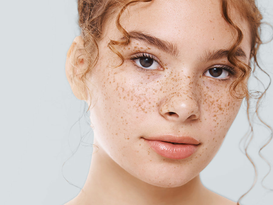 Laser Pigmentation Removal
