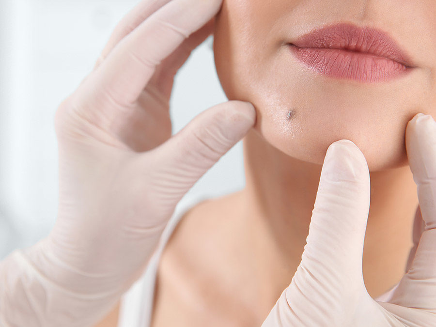 Laser Lesion Removal