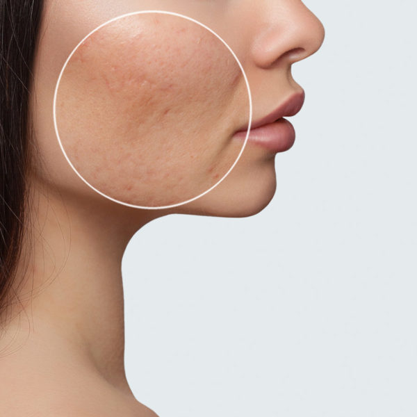 Scar Removal