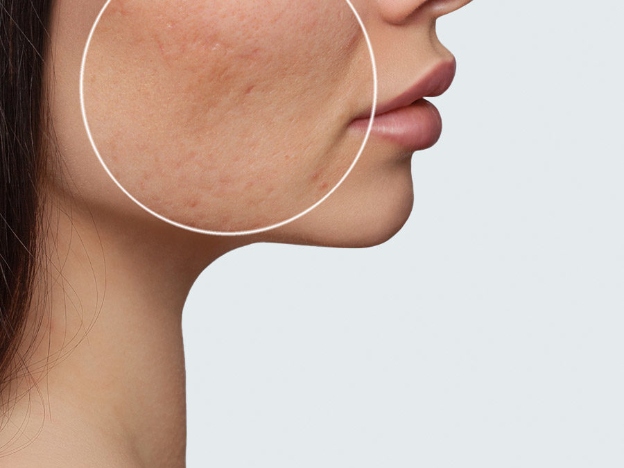 Laser Scar Removal