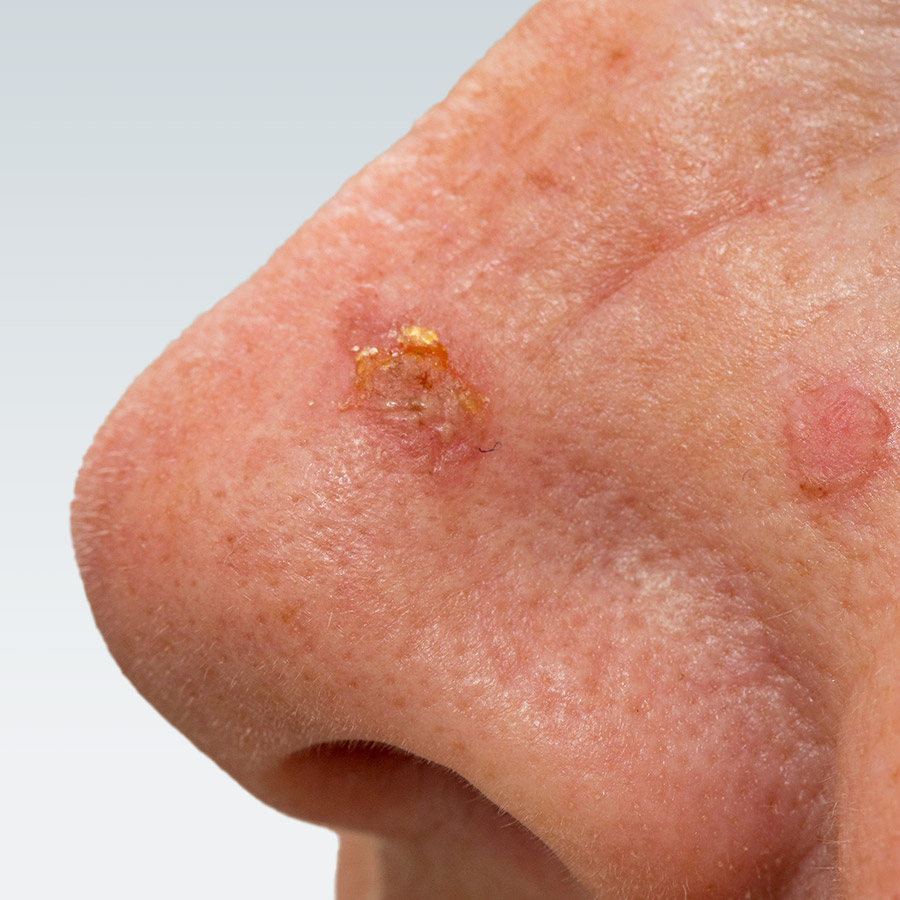Actinic Keratosis Skin Physicians Dermatology