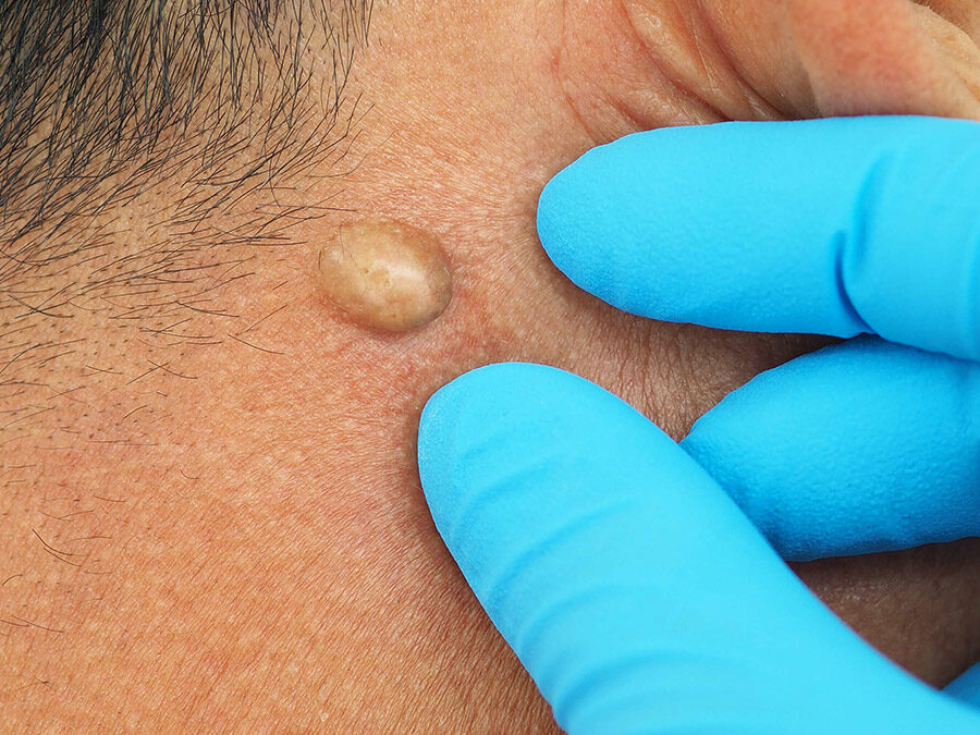Cyst Removal
