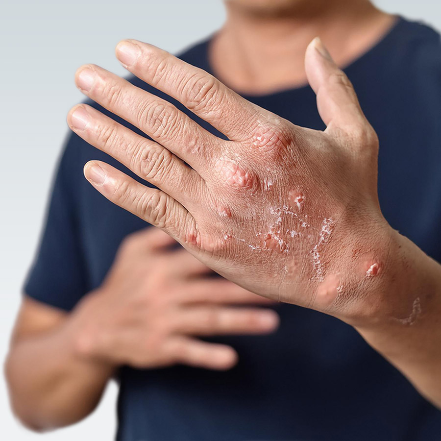 Eczema