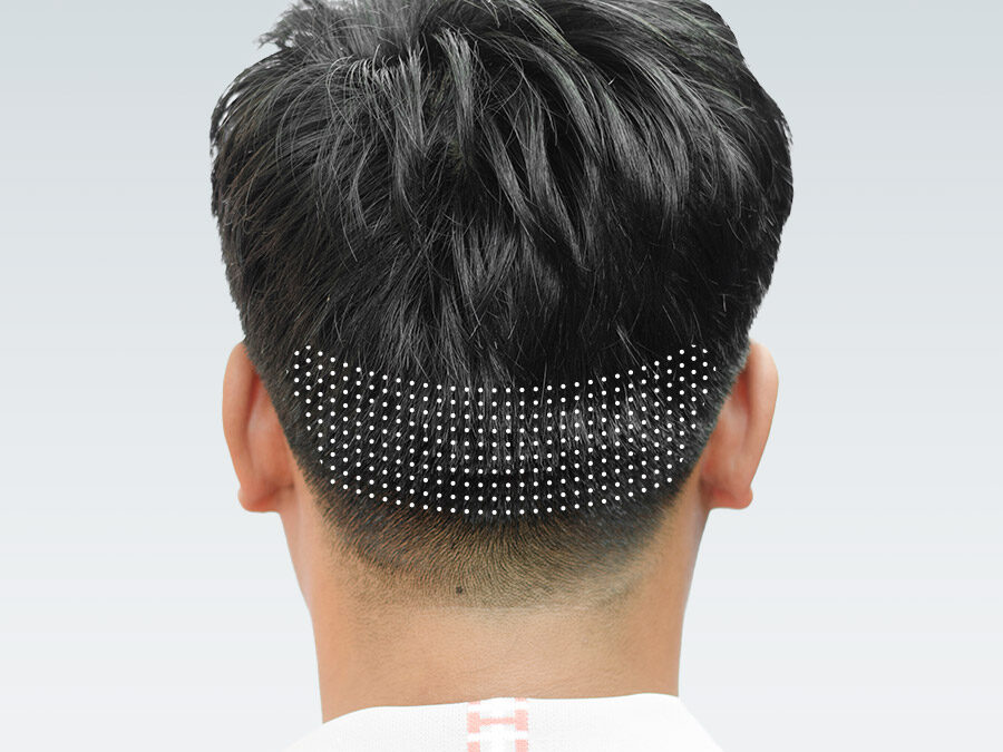 FUE (Follicular Unit Extraction)