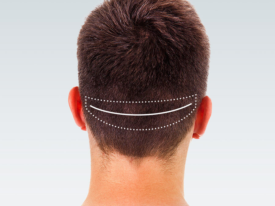 FUT (Follicular Unit Transplant)