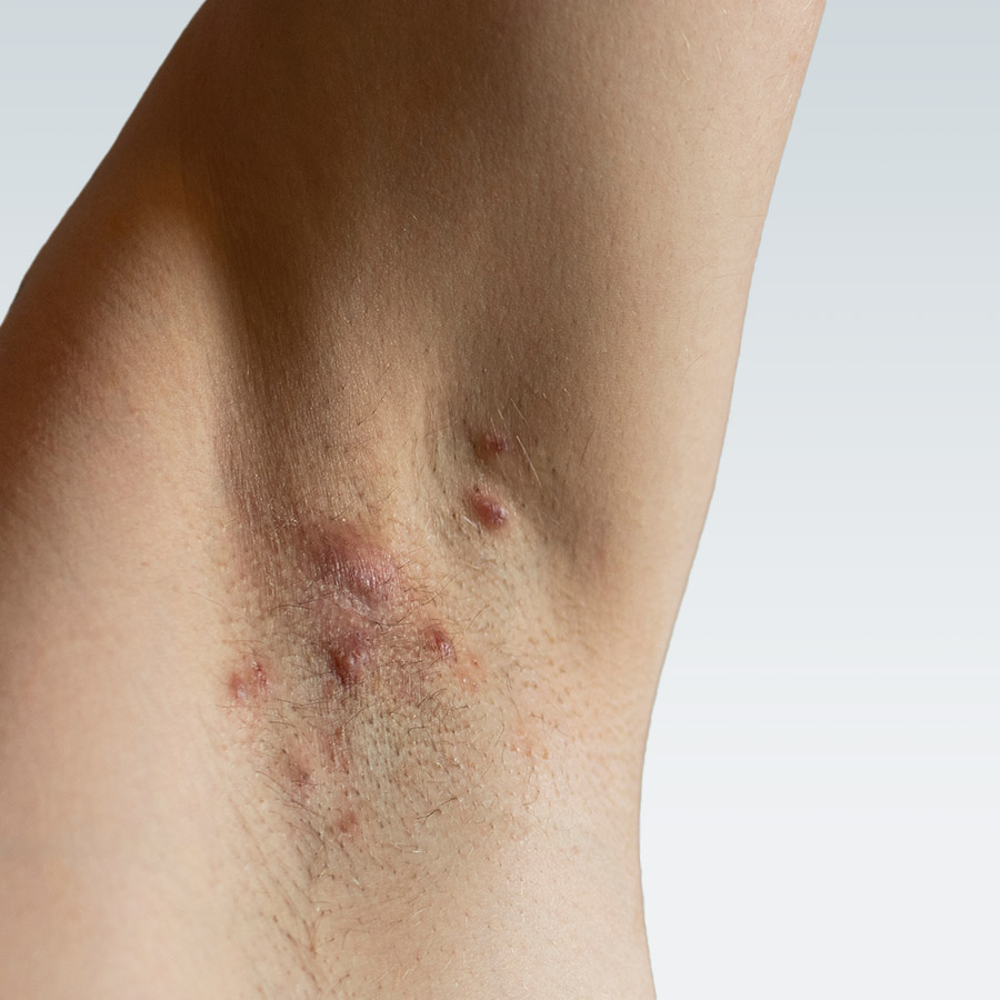 Hidradenitis Suppurativa