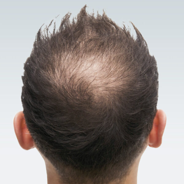 Male-Pattern Hair Loss