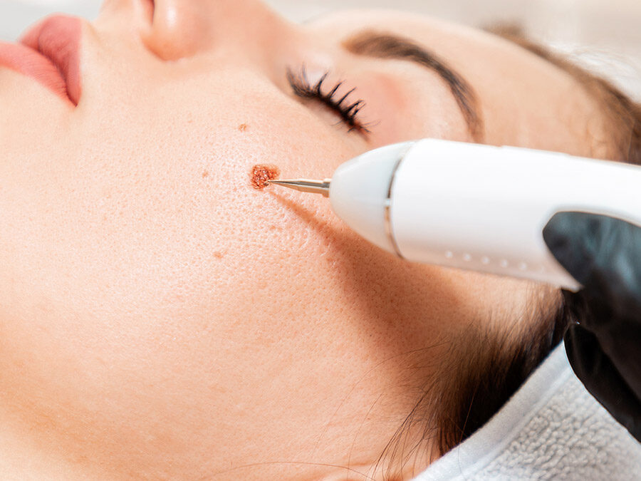 Mole Removal