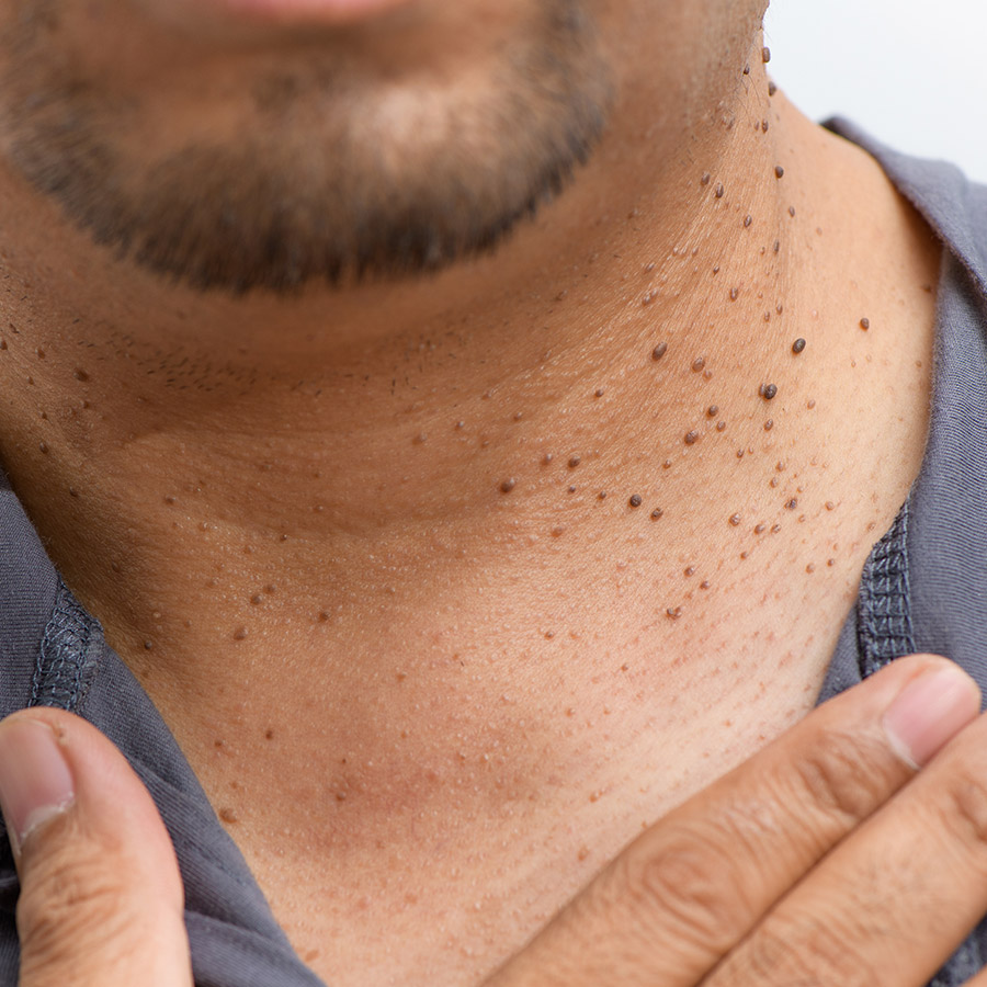 Seborrheic Keratosis