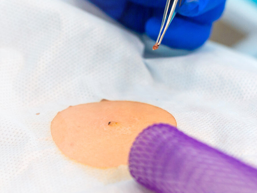 Skin Biopsy