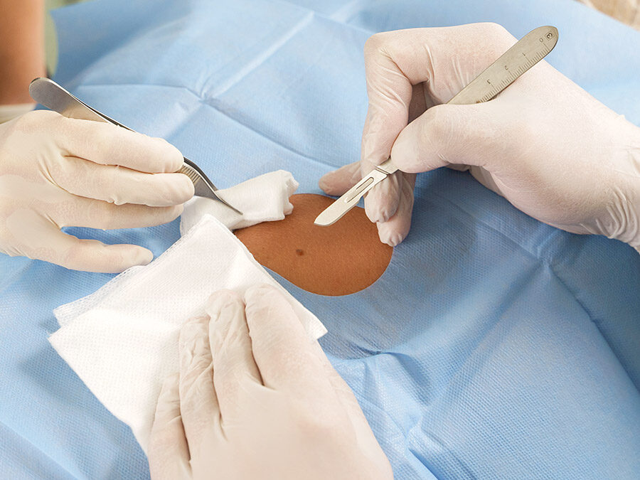 Skin Cancer Surgery