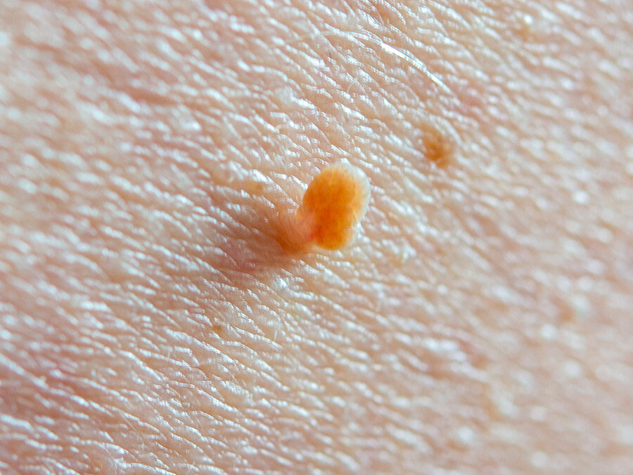 Skin Tag Removal