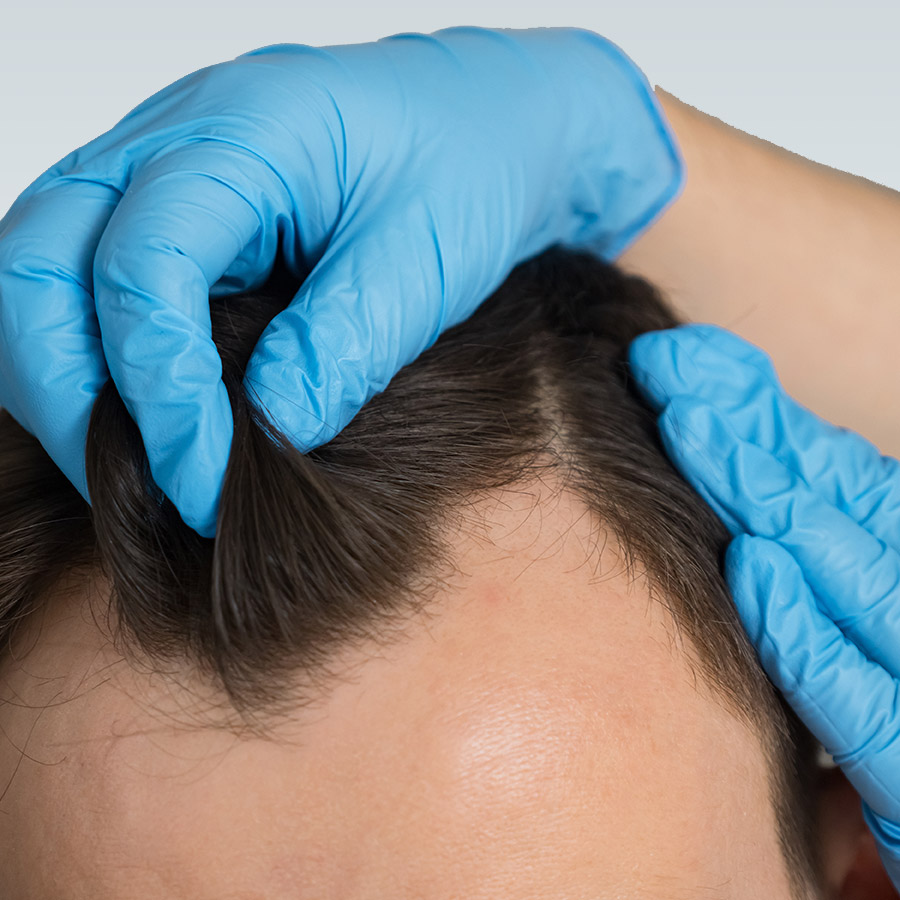 Transgender Hair Transplant
