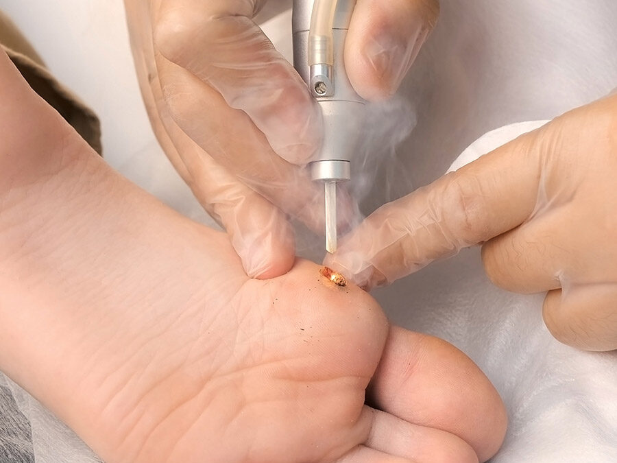 Wart Removal