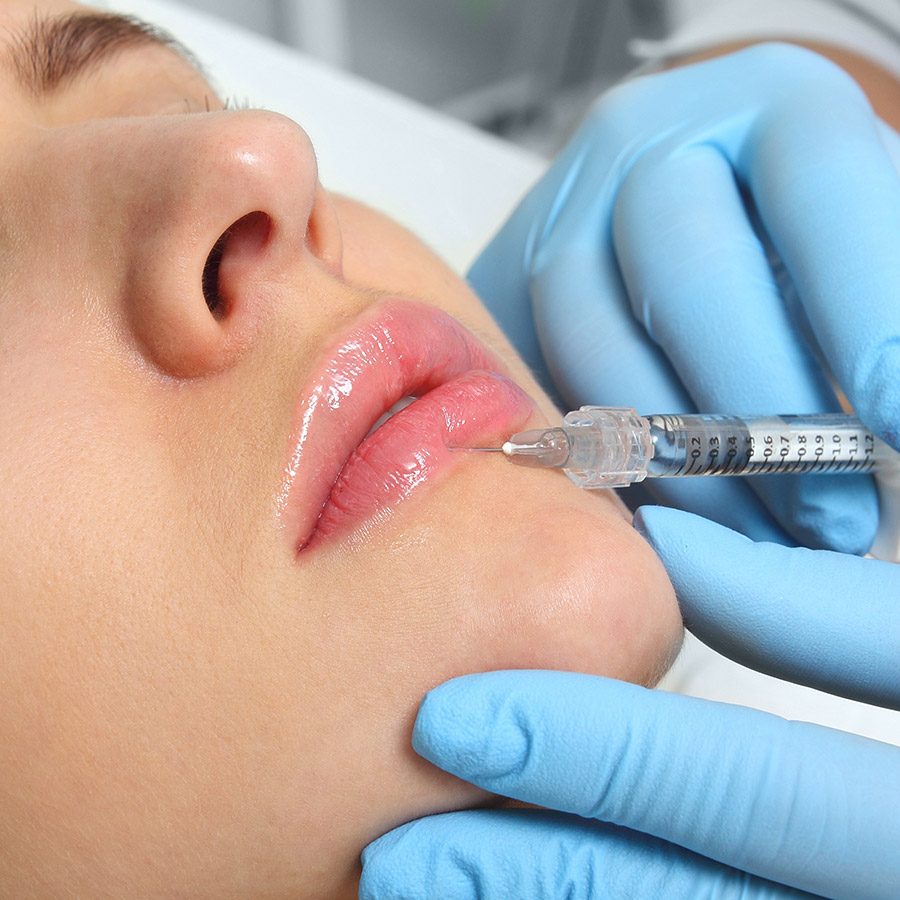 Lip Filler